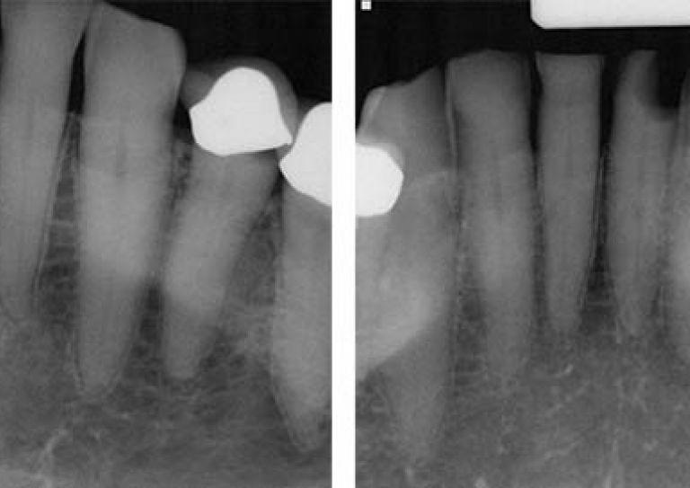 25号牙D3远端近端病变x线片. 这种被称为SMART的技术可以帮助修复牙齿损伤，防止龋齿，而不需要多次预约.