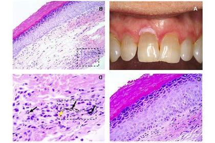 Fig. 1. (A) Clinical image showing a white lesion involving the facial marginal gingiva of tooth #9. (Courtesy of Dr. Reid Lester). (B) Representative photomicrograph showing hyperorthokeratosis and foreign material in the deep lamina propria (square) (hematoxylin and eosin [H&E]; original magnification £ 200). (C) High-power view of the same case shows that the epithelium exhibits dyskeratosis, cellular discohesion, and nuclear pleomorphism limited to the lower one-third of the epithelial thickness—mild dy
